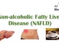 Non-Alcoholic Fatty Liver Disease, Risk Factors, Symptoms (ex. Fatigue), Treatment (ex. Coffee)