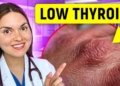 15 Signs of HYPOTHYROIDISM You Can See: Doctor Explains