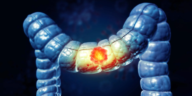 A stiffening colon may be fueling cancer in younger adults