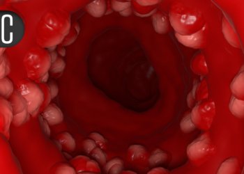 Advanced IBD Therapies Not Tied to Delayed Time to Pregnancy