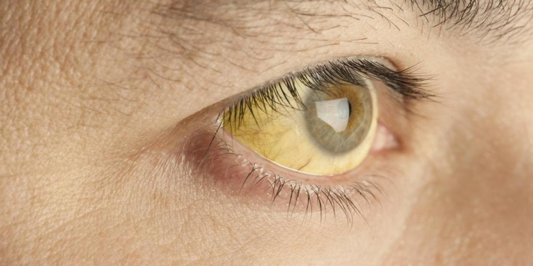 All you need to know about: Hepatitis A