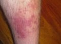 All you need to know about: cellulitis