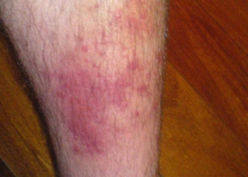 All you need to know about: cellulitis