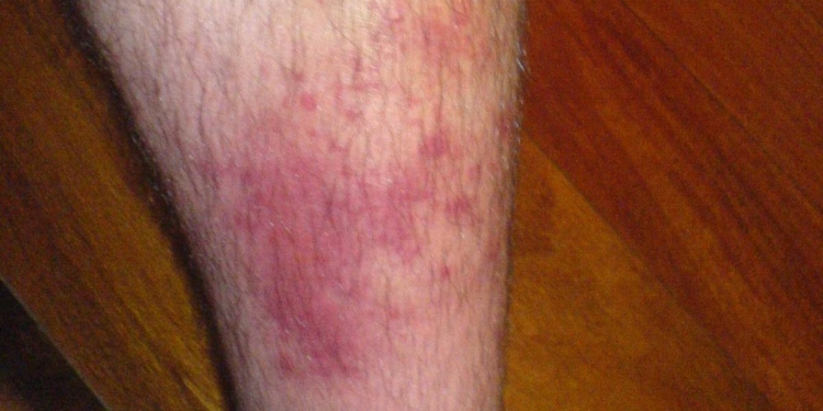 All you need to know about: cellulitis