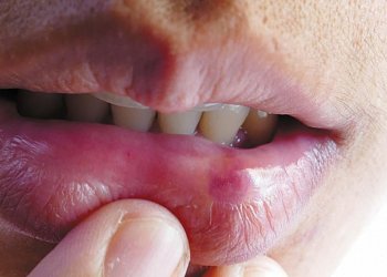 Burning mouth syndrome: The scorching reality - Harvard Health