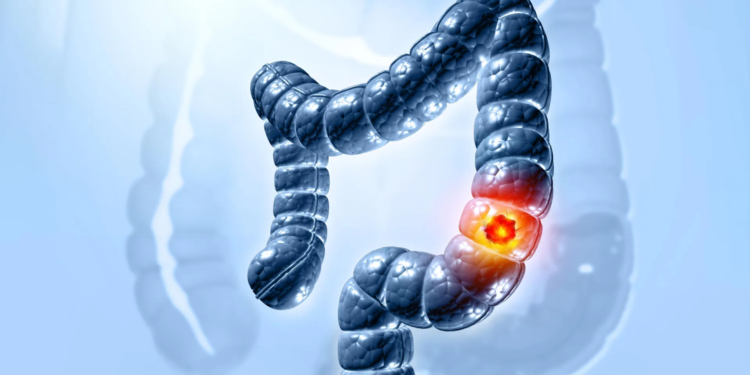 Colon cancer is surging in younger adults and doctors are alarmed