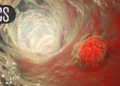 Immuno-Oncology Tops Embolization for Intermediate-Grade Liver Cancer