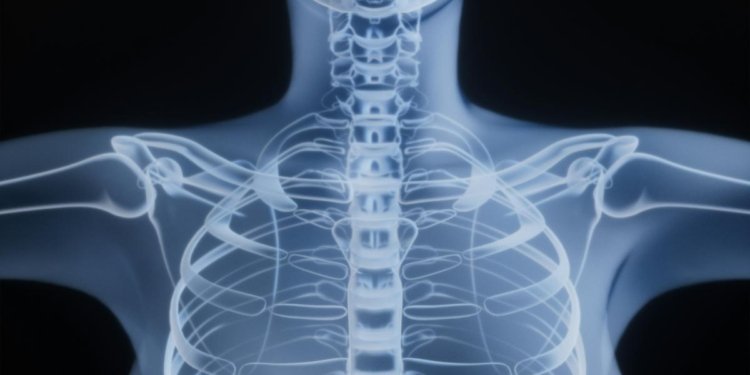 Large genetic study finds overlaps between schizophrenia, bone health