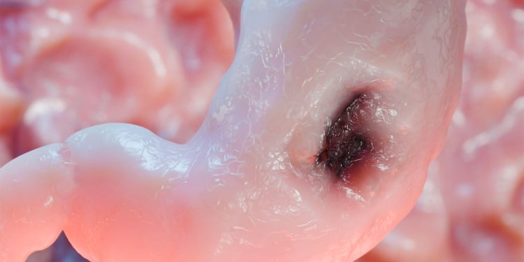 Long-Term Anti-Acid Drugs and Stomach Cancer: Is There a Link?