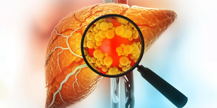 MIT study shows high-fat diets give liver cancer a dangerous head start