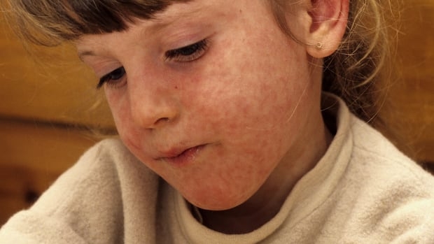 Child with measles.