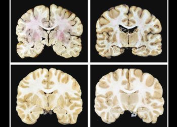 Not All CTE Leads to Dementia, Large Study Shows