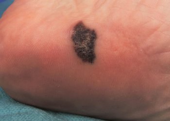 PD-1 Inhibitor Raises PFS in Advanced Acral Melanoma