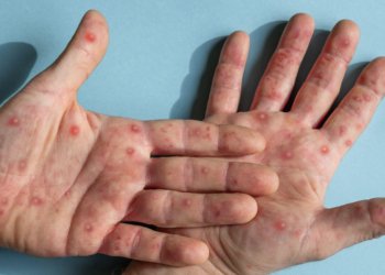 Post-Mpox Side Effects Persisted More Than a Year After Acute Infection