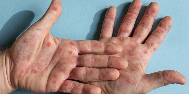 Post-Mpox Side Effects Persisted More Than a Year After Acute Infection