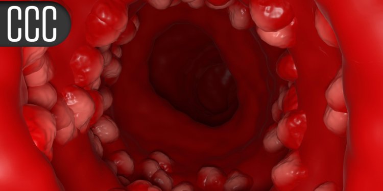 Prior Biologic Use Tied to JAK Inhibitor Benefit in Ulcerative Colitis