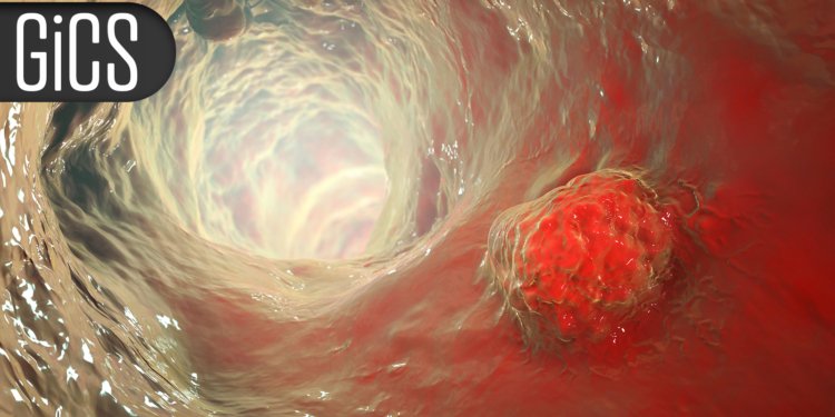 Regular Physical Activity Thwarts Fatigue, Boosts QoL in Colorectal Cancer