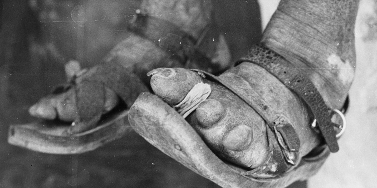 The story of dapsone: from dye to drug