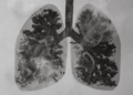 Unusual carbon build-up found in lungs of COPD patients