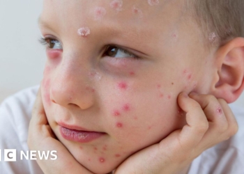 What is chickenpox and who can get the NHS vaccine?