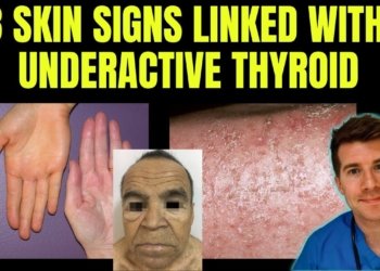 Doctor explains 8 SKIN SIGNS linked with HYPOTHYROIDISM (aka underactive thyroid)