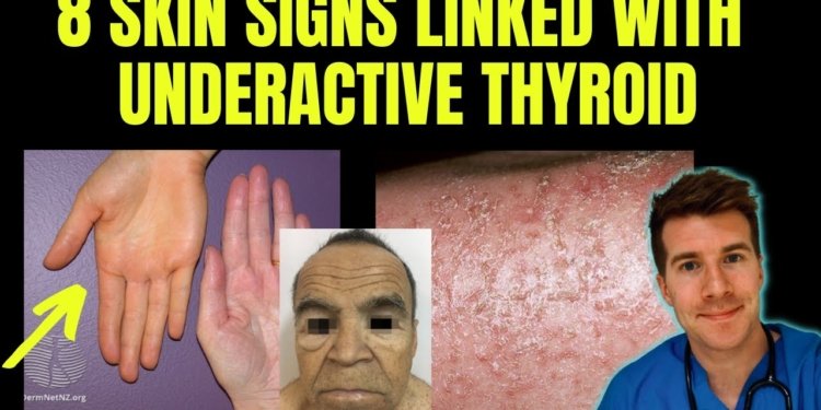 Doctor explains 8 SKIN SIGNS linked with HYPOTHYROIDISM (aka underactive thyroid)
