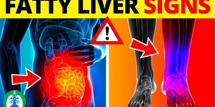 ⚡ Top 10 Signs and Symptoms of Fatty Liver You MUST AVOID