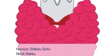 Laboratory data of subclinical hypothyroidism and hyperthyroidism