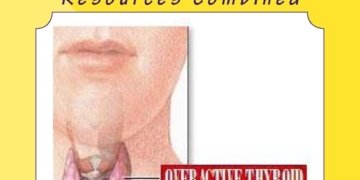 Hyperthyroidism – the Best Darn Complete Look: Two Popular Hyperthyroid Resources Combined