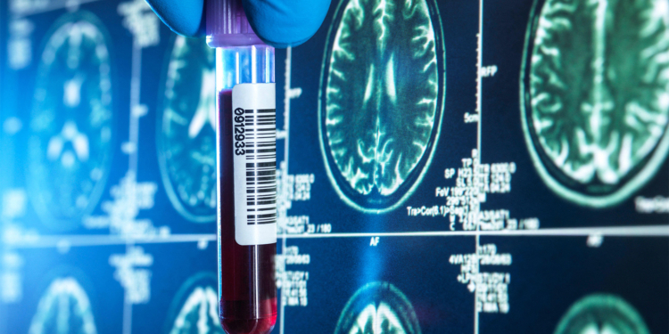 Alzheimer's 'Clock' Uses Blood Test to Forecast Symptom Onset