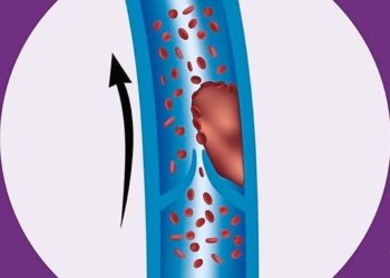 Antiphospholipid syndrome: When your blood 'sticks' together