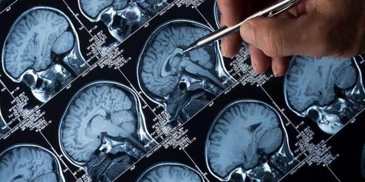 Experts emphasise early diagnosis, long-term care and policy support for people living with epilepsy