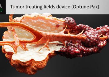 First-of-Its-Kind Device for Pancreatic Cancer Wins FDA Approval