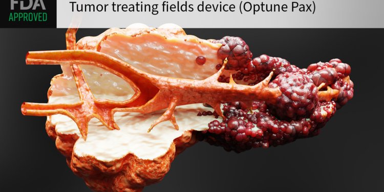 First-of-Its-Kind Device for Pancreatic Cancer Wins FDA Approval