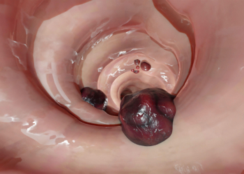 Here's Exactly How High Colorectal Cancer Risk Is for IBD Patients