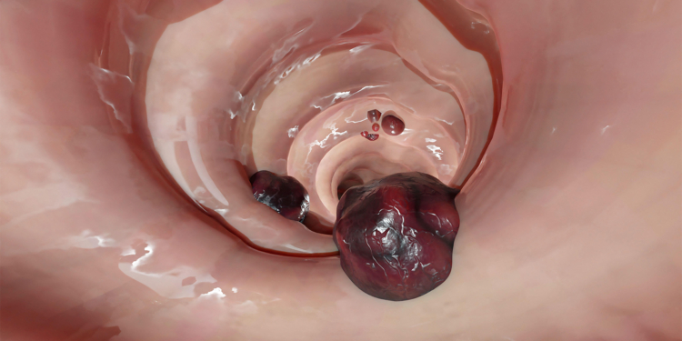 Here's Exactly How High Colorectal Cancer Risk Is for IBD Patients