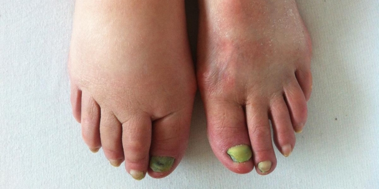 Lymphoedema care: from early detection to long-term management