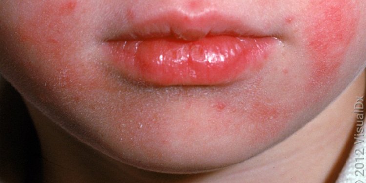 Make the Diagnosis: What’s this Rash, and Is Her Family History Relevant?