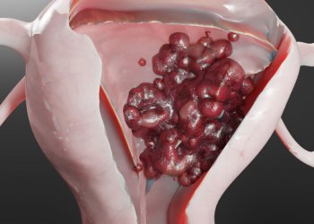 More Good News for GLP-1 Agonists and Cancer Risk