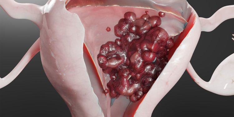 More Good News for GLP-1 Agonists and Cancer Risk