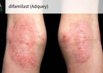 New Topical PDE4 Inhibitor Gets FDA Green Light for Chronic Skin Disease
