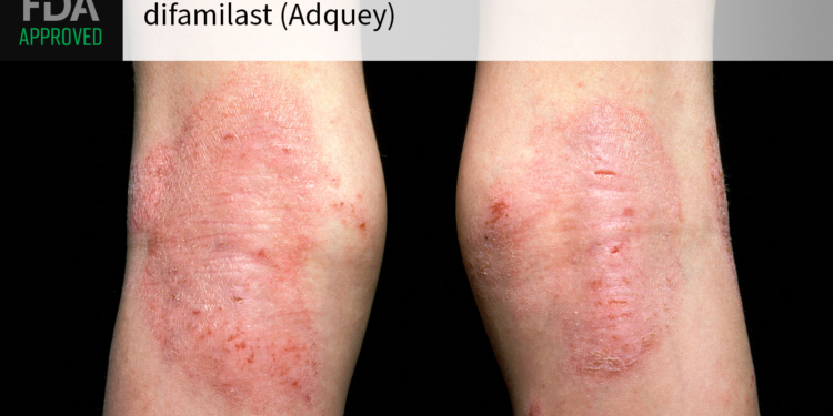 New Topical PDE4 Inhibitor Gets FDA Green Light for Chronic Skin Disease