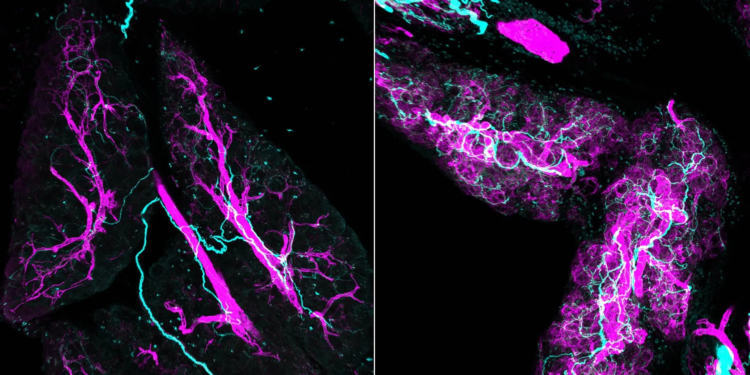 Scientists find nerves actively fuel pancreatic cancer