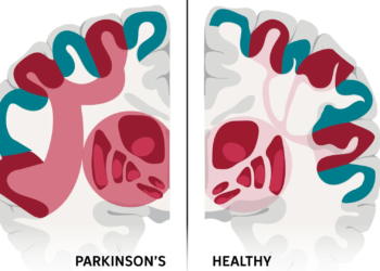 Scientists may have found the brain network behind Parkinson’s