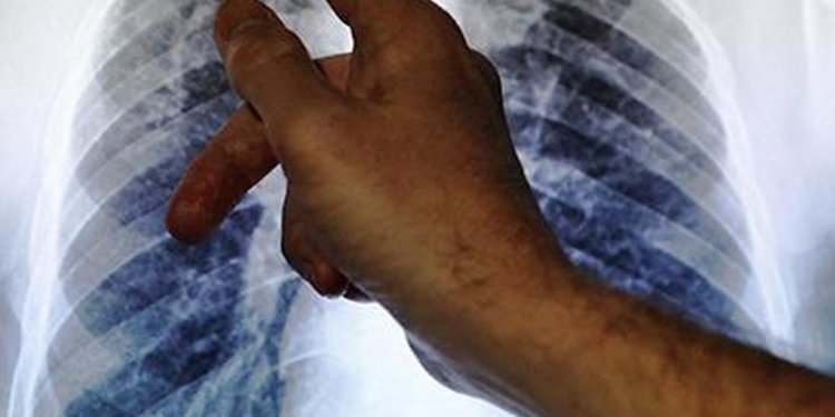 Shorter all-oral TB regimens cost-effective in India: ICMR study