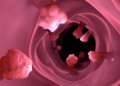 Study Supports Personalized Surveillance for Colon Polyp Recurrence Risk