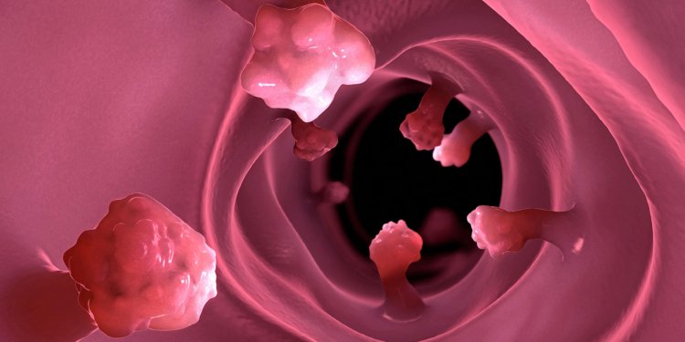 Study Supports Personalized Surveillance for Colon Polyp Recurrence Risk