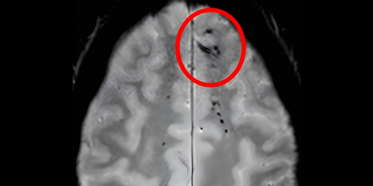 Tiny Blood Smidges in the Brain: Amount and Location Tied to Dementia