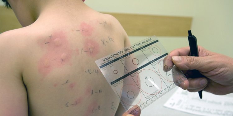 U.S., Australia Lead the World on Kids' Food Allergy Rates