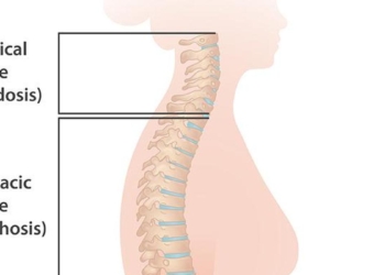 Why delaying spine surgery can lead to permanent disability